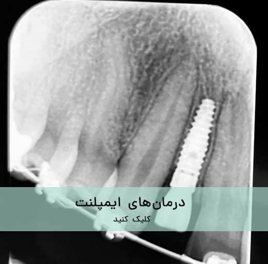 درمان های ایمپلنت