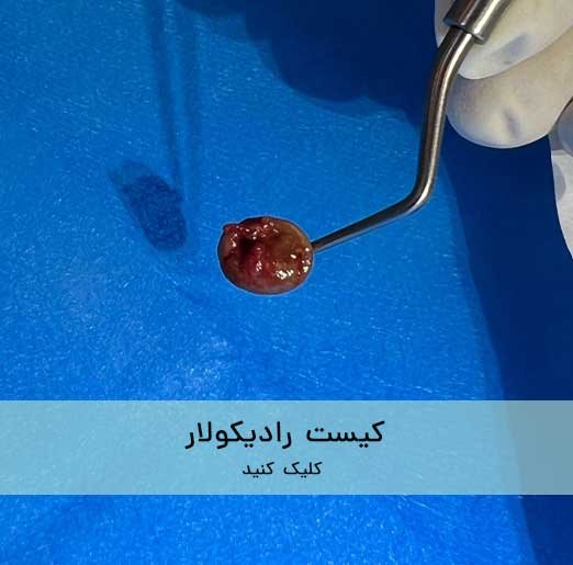 درمان های با لیزر