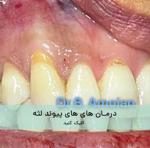 جراحی های لثه