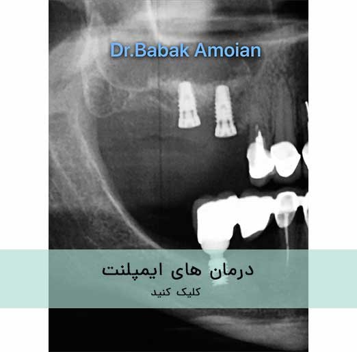 درمان های ایمپلنت