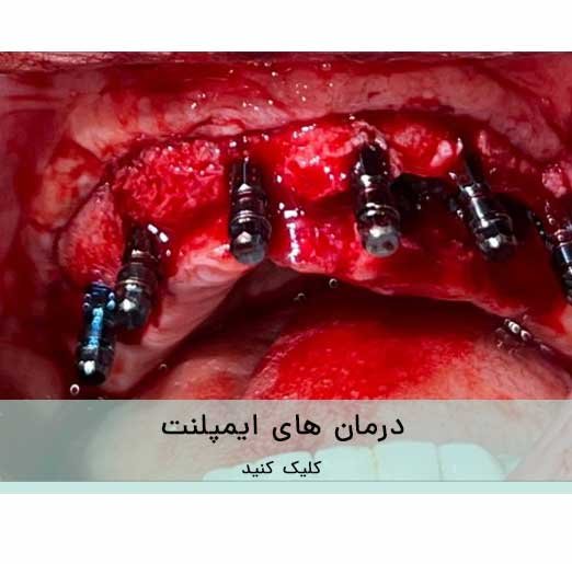 درمان های ایمپلنت
