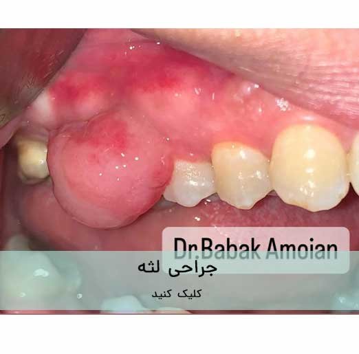 جراحی های لثه