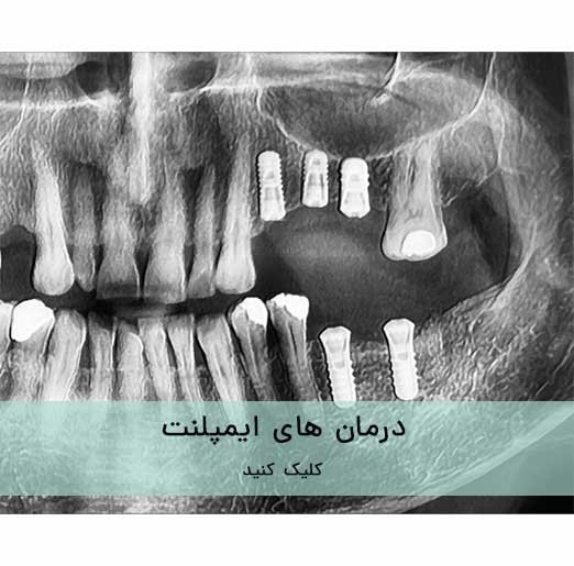 درمان های ایمپلنت