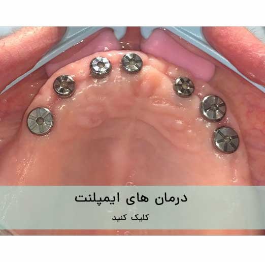 درمان های ایمپلنت