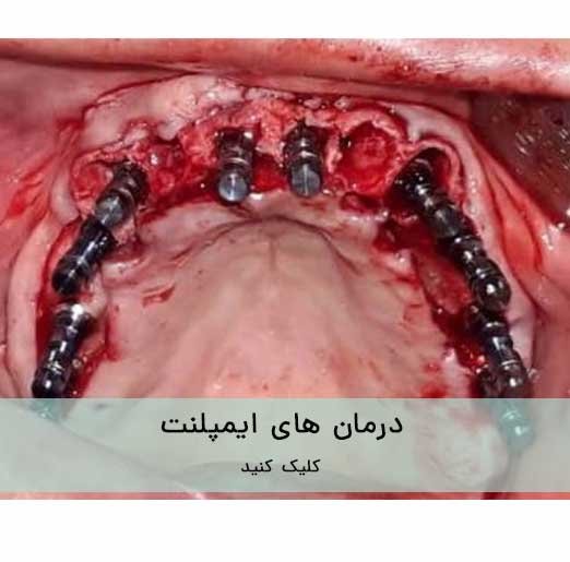 درمان های ایمپلنت