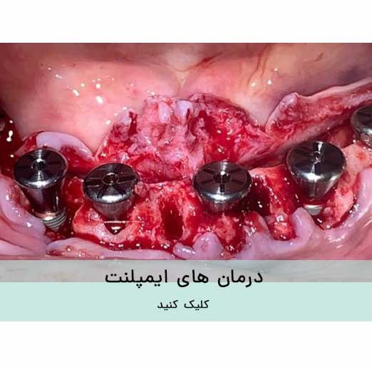 درمان های ایمپلنت