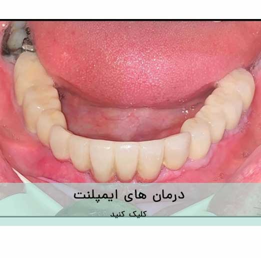 درمان های ایمپلنت