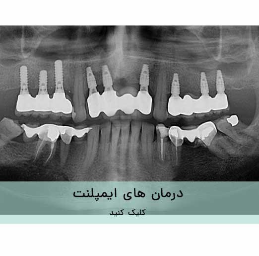 درمان های ایمپلنت