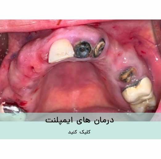 درمان های ایمپلنت