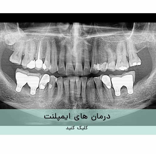 درمان های ایمپلنت