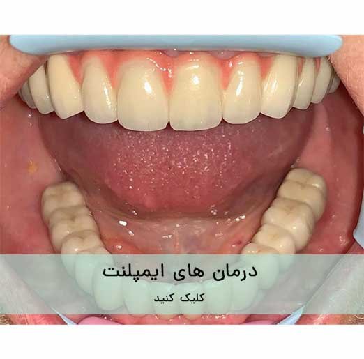 درمان های ایمپلنت در فرد با بی دندانی کامل