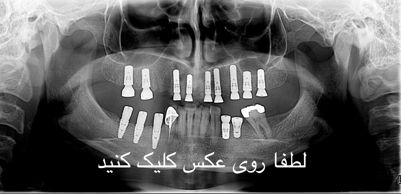 ایمپلنت