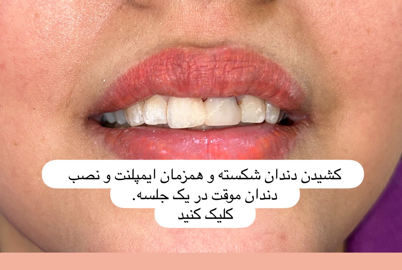 ایمپلنت فوری و نصب دندان موقت در یک جلسه