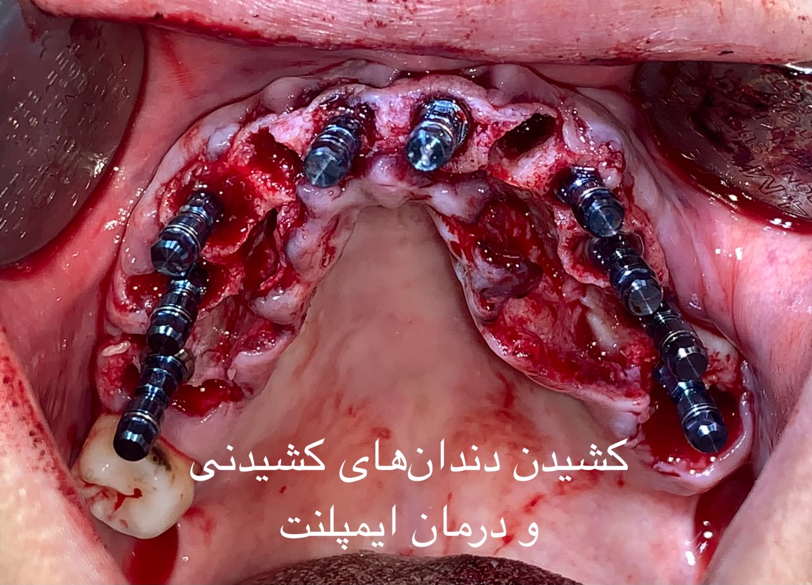 کشیدن دندانهای پوسیده و همزمان ایمپلنت