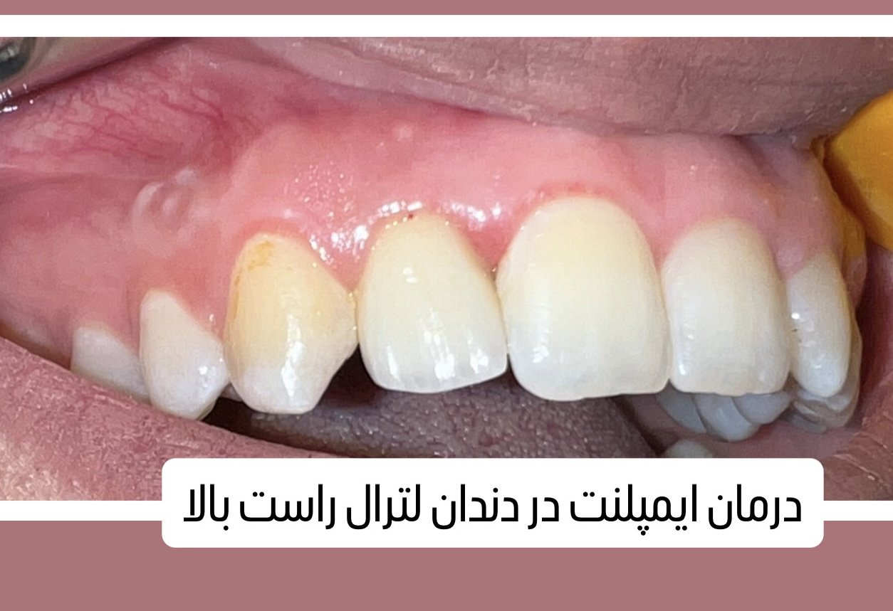 جایگزینی دندان ثنایای کناری فک بالا با ایمپلنت