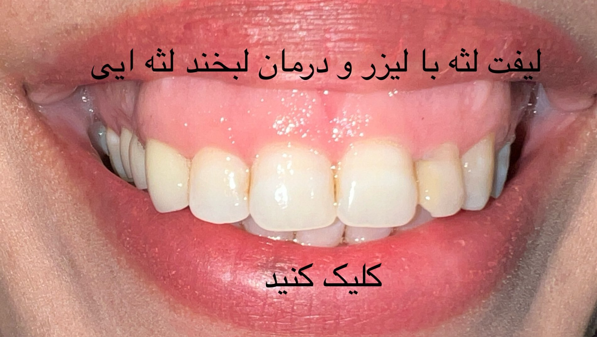 لیفت و درمان (Gummy Smile) لبخند لثه ای با لیزر
